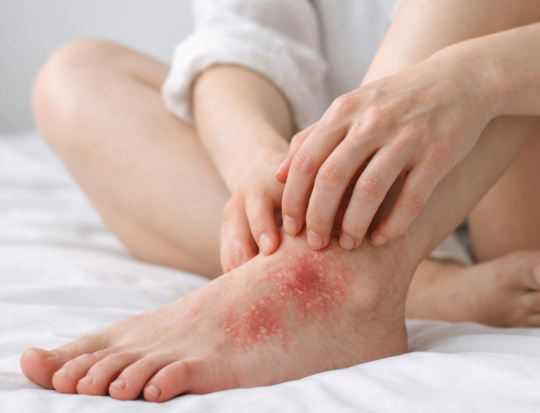 eczéma pieds dyshidrosique